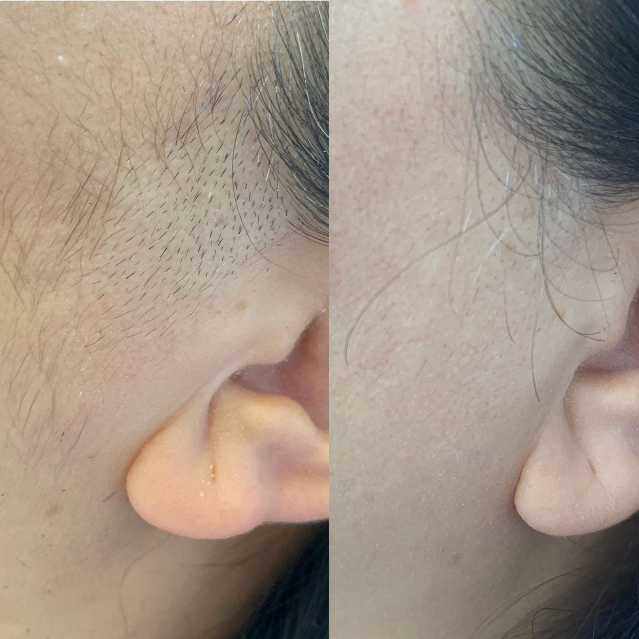 Facial Treatment Before/After Results