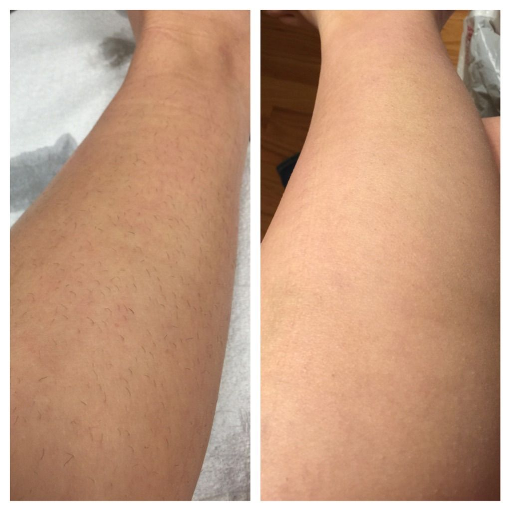 Legs Treatment Before/After Results