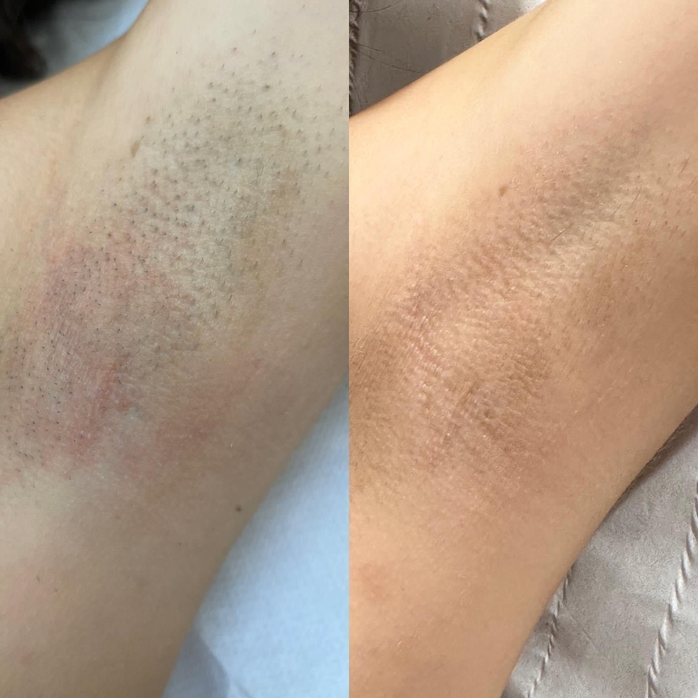 Underarms Treatment Before/After Results